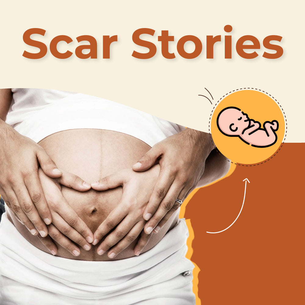 The Stories in Our Scars: Belly Lines, Birth Marks and Why We Don’t Edit Them Out